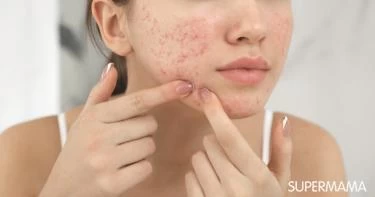 أعراض ارتفاع هرمون الغدة الكظرية