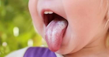 علاج فطريات الفم عند الأطفال عمر سنة ونصف