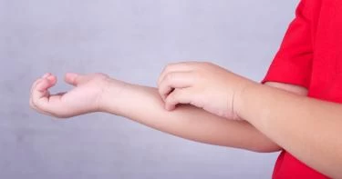 أعراض الجرب عند الأطفال