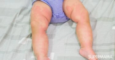أعراض الأرتيكاريا عند الرضع