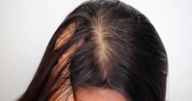 ما هي فوائد زيت الخردل للشعر الخفيف؟