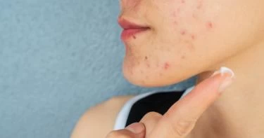 5 فوائد لكريم أكرتين ستدهشكِ معرفتها!