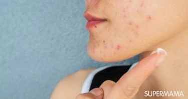 5 فوائد لكريم أكرتين ستدهشكِ معرفتها!