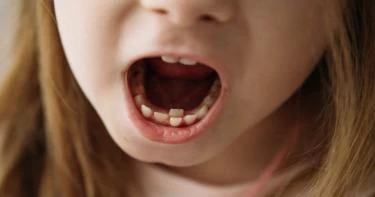 أسنان القرش عند الأطفال: ما المقصود بها؟