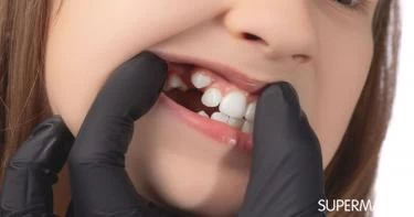 ظهور الأنياب عند الأطفال