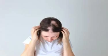 أعراض الثعلبة عند النساء: إليكِ أهمها