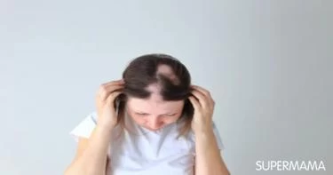 أعراض الثعلبة عند النساء: إليكِ أهمها
