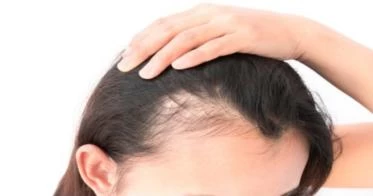 علاج صلع النساء من الأمام
