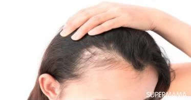 علاج صلع النساء من الأمام