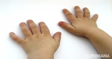 قضم الأظافر عند الأطفال