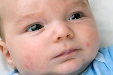 لماذا يوجد حبوب بيضاء في وجه الرضيع؟
