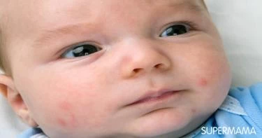 لماذا يوجد حبوب بيضاء في وجه الرضيع؟