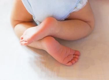 التقوس عند الأطفال