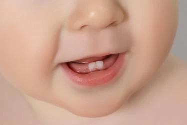 تأخر التسنين عند الأطفال