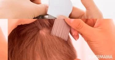 علامات إصابة الطفل بالقمل وعلاجه