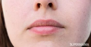 أعراض حساسية الشمس