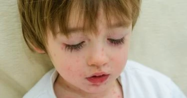 أعراض الحصبة عند الأطفال وعلاجها