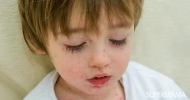 أعراض الحصبة عند الأطفال وعلاجها