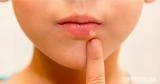 ما أعراض الهربس عند الأطفال؟